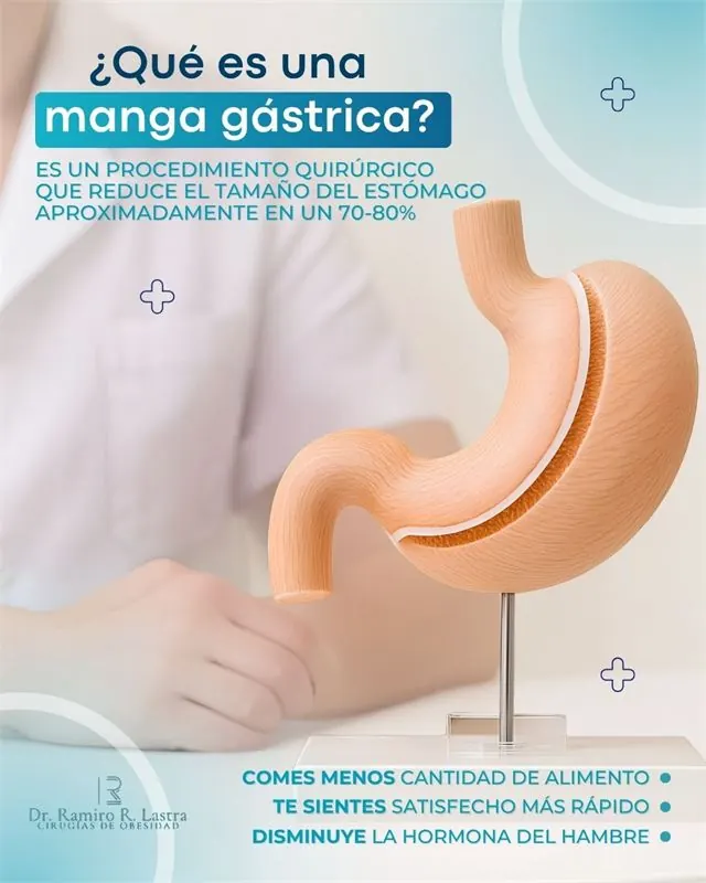 Publicación que explica qué es la manga gástrica